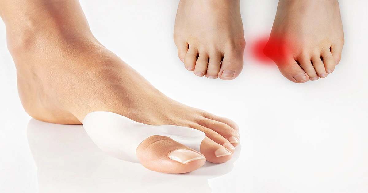 Hallux Valgus Surgery